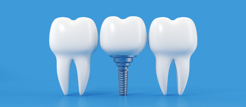 Dental Implants in Albania